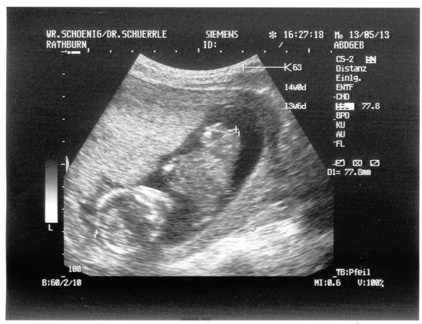 Ultrasound 13May2013c